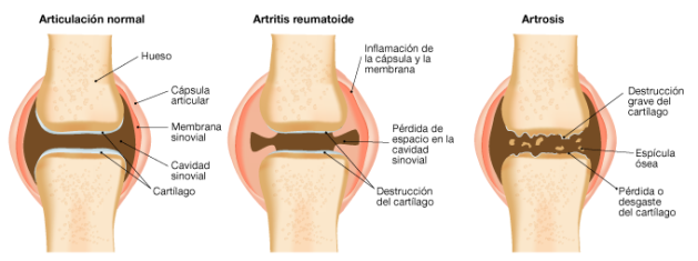 Resultado de imagen de artrosis y artritis